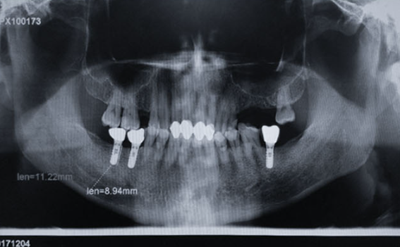 Zhuo Shiyou Implant System Clinical Cases Phase 3 (2).png