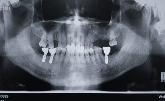Zhuo Shiyou Implant System Clinical Cases Phase 3 (3).png