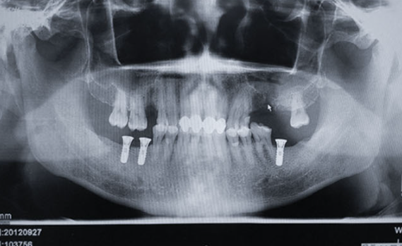 Zhuo Shiyou Implant System Clinical Cases Phase 3 (4).png