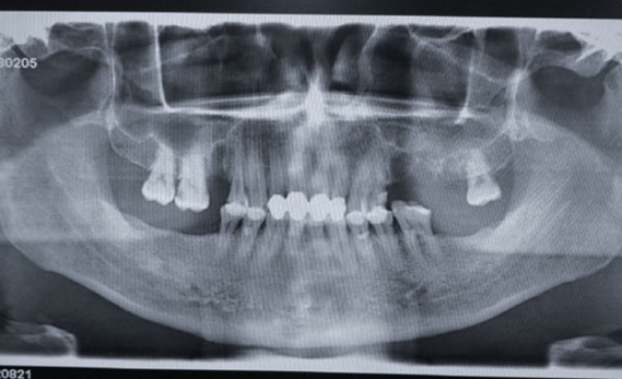 Zhuo Shiyou Implant System Clinical Cases Phase 3 (5).png