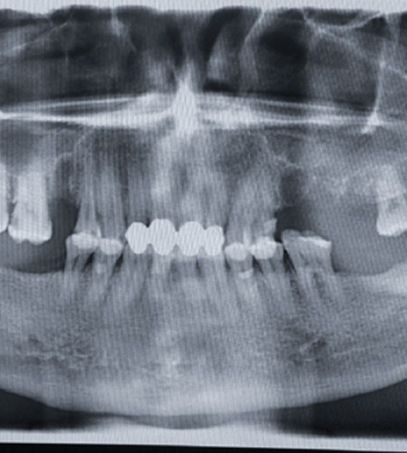 Trusyou Implant System Clinical Cases Phase 3
