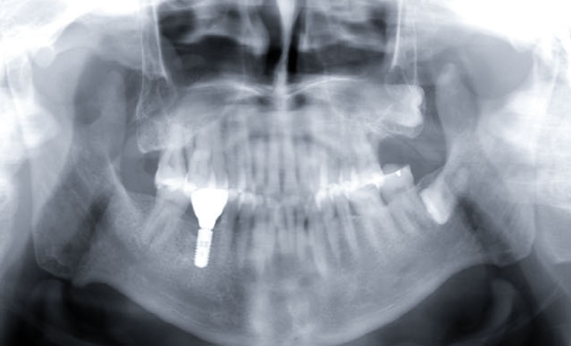 Zhuo Shiyou Implant System Clinical Cases Phase 4 (1).png