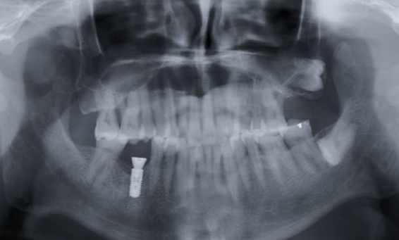 Zhuo Shiyou Implant System Clinical Cases Phase 4 (2).png