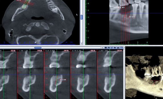 Zhuo Shiyou Implant System Clinical Cases Phase 4 (3).png