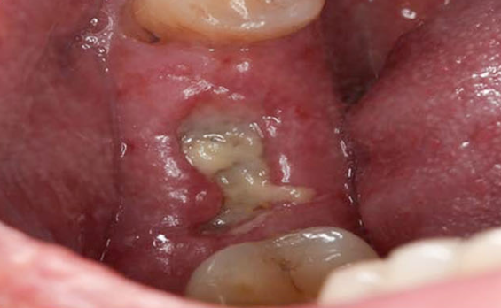 Zhuo Shiyou Implant System Clinical Cases Phase 4 (4).png