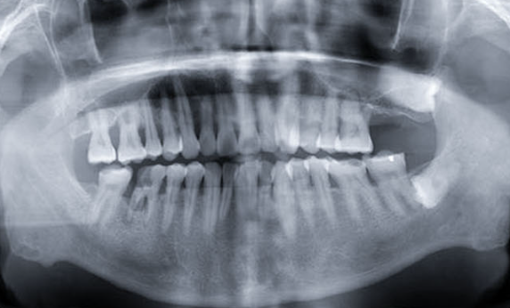 Zhuo Shiyou Implant System Clinical Cases Phase 4 (5).png