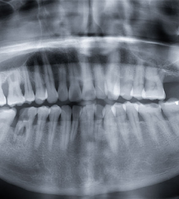 Trusyou Implant System Clinical Cases Phase 4