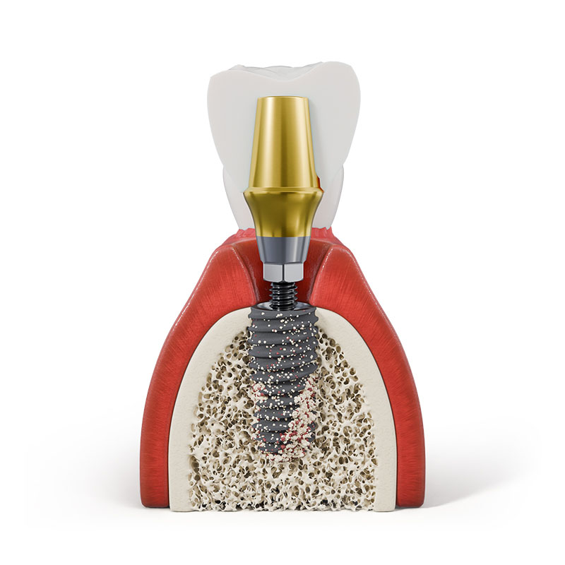 What is a healing abutment and what is its role in dental implant surgery?