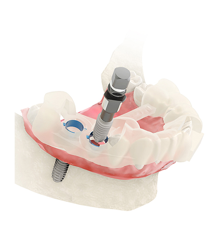 Trusyou’s 100% digital process revolutionizes dental implants